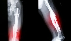 Los Angeles Orthopedic Injury Lawyers | Simmrin Law Group Los Angeles Orthopedic Injury Lawyer