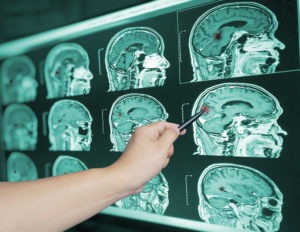 Traumatic Brain Injury Lawyer in Los Angeles, CA | Simmrin Law doctor pointing at brain scan