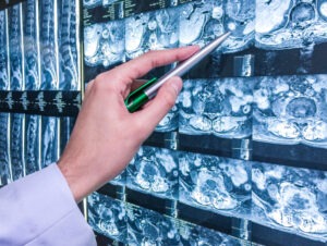 Thousand Oaks Spinal Cord Injury Lawyer