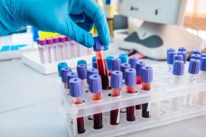 How Long does It Take for DUI Blood Samples to Come Back?